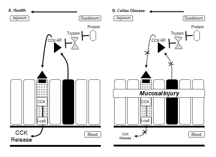 Exocrine Pancreatic Insufficiency And Pancreatitis Associated With Celiac Disease Pancreapedia